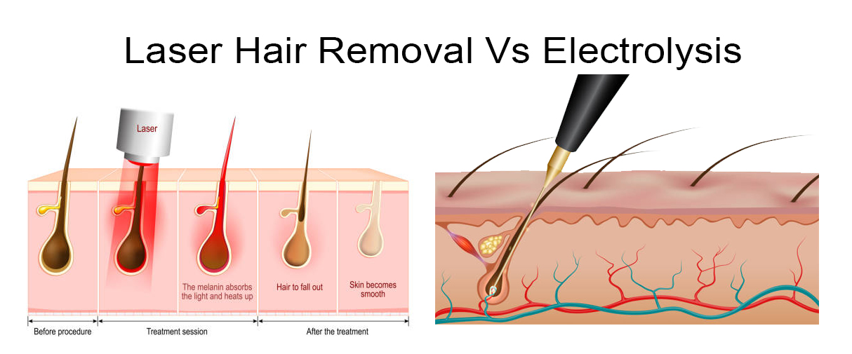 laser-hair-removal-vs-electrolysis-electrolysis-vs-laser-hair-removal